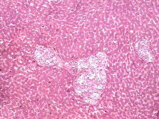 Cryptococcus - Liver - <div style=